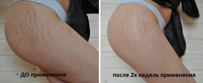 Фото до и после применения крема от растяжек с таблетками мумие