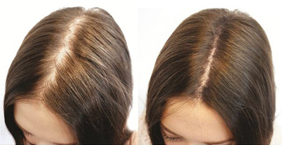 Дарсонваль для волос, фото до и после использования