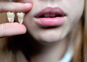Гранулема и киста зуба