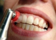 Зубные отложения (гигиена зубов)