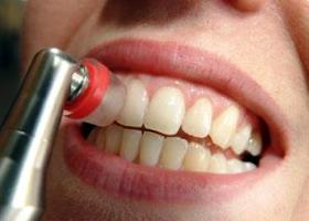 Зубные отложения (гигиена зубов)