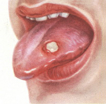 Язвенный стоматит, фото язвы на языке