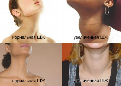 Увеличение щитовидной железы, фото