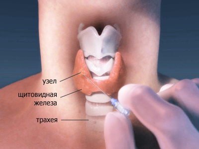 Узлы щитовидной железы, фото