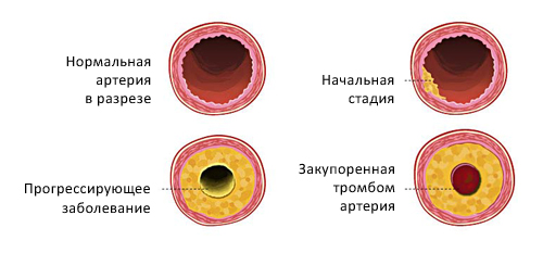 Фото холестериновых бляшек