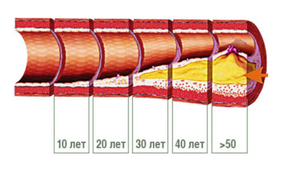 Накопление холестерина в сосудистой стенке