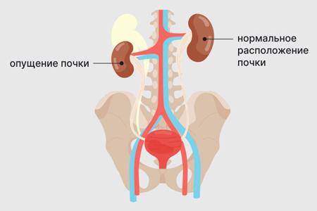 Опущение почки