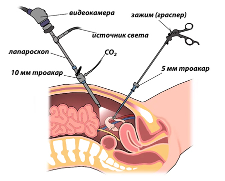 Лапароскопическая операция по удалению спаек в кишечнике