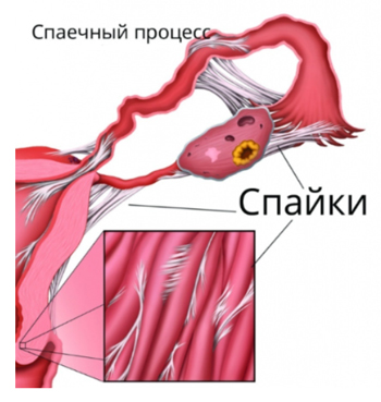 Внешний вид спаек кишечника