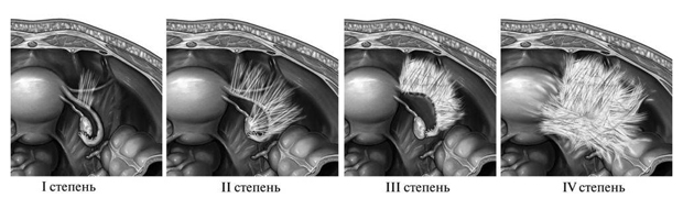 Степени запущенности спаек в кишечнике