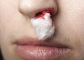 Причины крови из носа: влияние внешних факторов