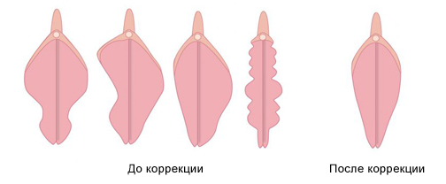 Коррекция объема и формы половых губ