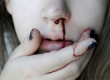 Причины кровотечения из носа
