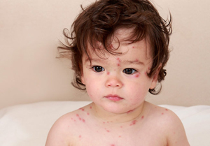 Фото сыпи при энтеровирусной инфекции у детей
