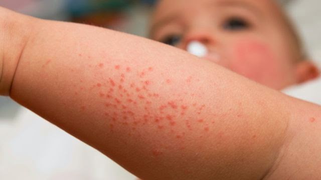 Как выглядит аллергия у ребенка на ногах