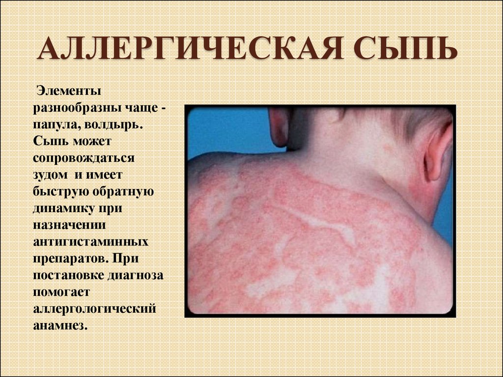 Аллергические высыпания на коже, фото