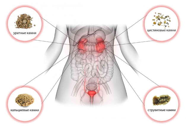 Виды камней в почках