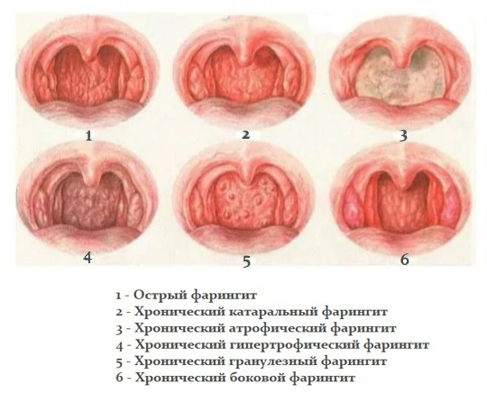 Разновидности фарингита