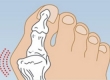 Косточка на большом пальце ноги