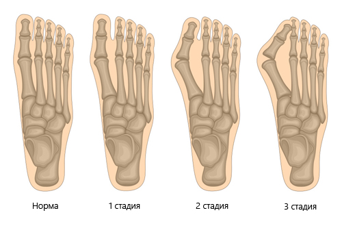 Стадии вальгусной деформации