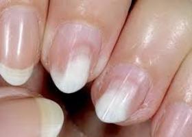 Как вылечить ногти когда слоятся ногти thumbnail