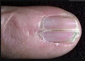 Как вылечить ломкие тонкие ногти thumbnail