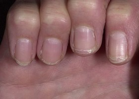 Почему слоятся ногти на руках причины и лечение в домашних условиях thumbnail