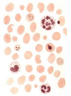 Картина крови при B12-дефицитной анемии
