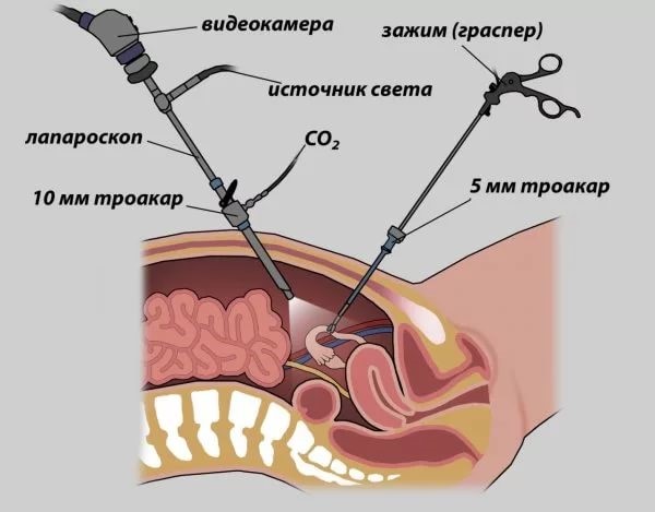 Как делают лапароскопию