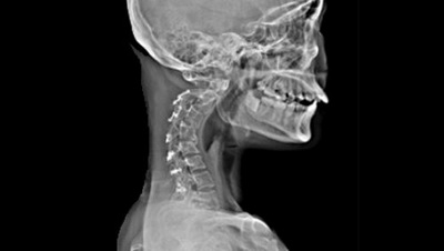 Рентгенологическое фото кифоза шейного отдела позвоночника
