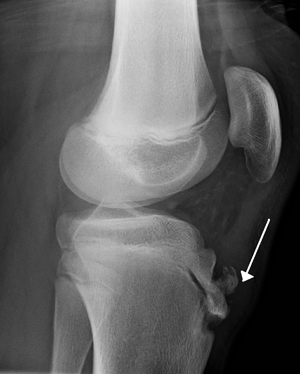 Рентгенография коленного сустава при болезни Осгуда-Шлаттера