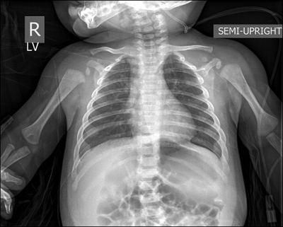 Рентгенография грудной клетки с пятнами бронхиолита