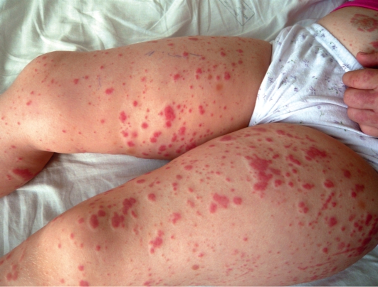 Токсический дерматит у детей по типу крапивницы