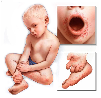 Вирус Коксаки у детей. Синдром "рука-нога-рот"