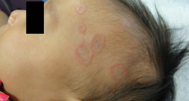 Кольцевидная гранулема у ребенка 3 года
