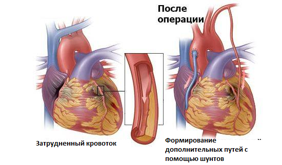 Состояние организма перед инфарктом