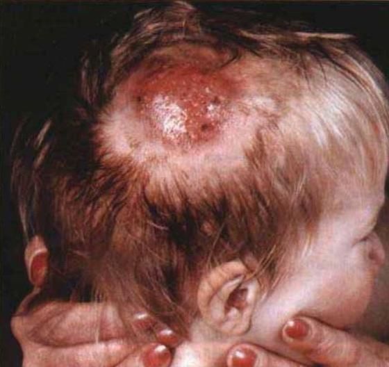 Грибок на коже головы лечение у детей