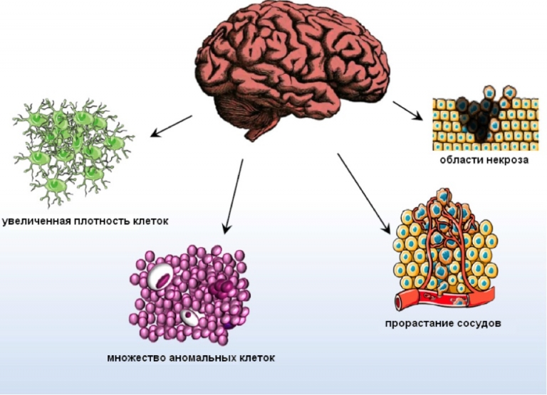 Глиобластома головного фото