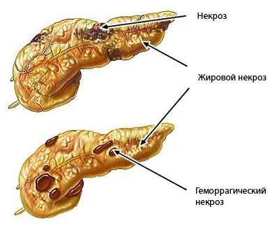 Основные формы панкреонекроза