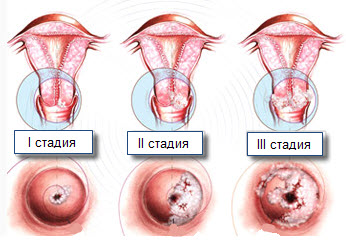 Народные средства лечения крауроз вульвы thumbnail