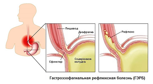 Гастроэзофагеальная рефлюксная болезнь (ГЭРБ)