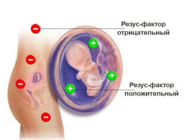 Синдромы при гемолитической болезни новорожденных thumbnail