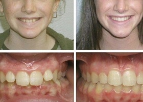 До и после лечения
