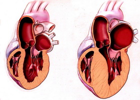 Гипертрофия левого желудочка сердца, правого желудочка