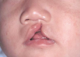 Заячья губа у человека, фото
