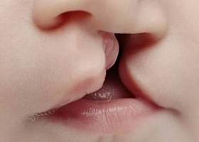 Заячья губа у детей, фото