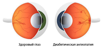 Сравнение здорового глаза и глаза с диабетической ангиопатией