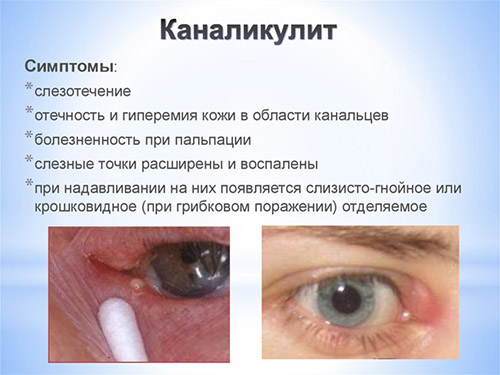Воспаление желез глаз лечение thumbnail