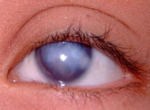 Бельмо на глазу (лейкома, паннус, помутнение роговицы)