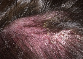 Фото микоза (грибка) волосистой части головы